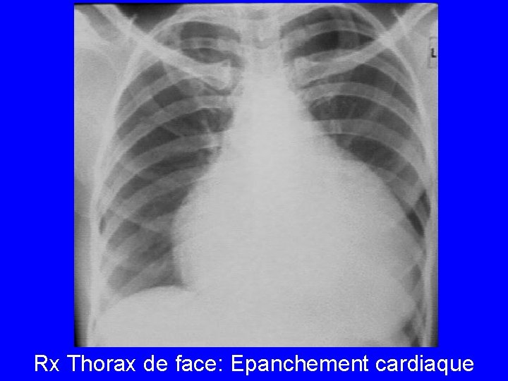 Rx Thorax de face: Epanchement cardiaque 