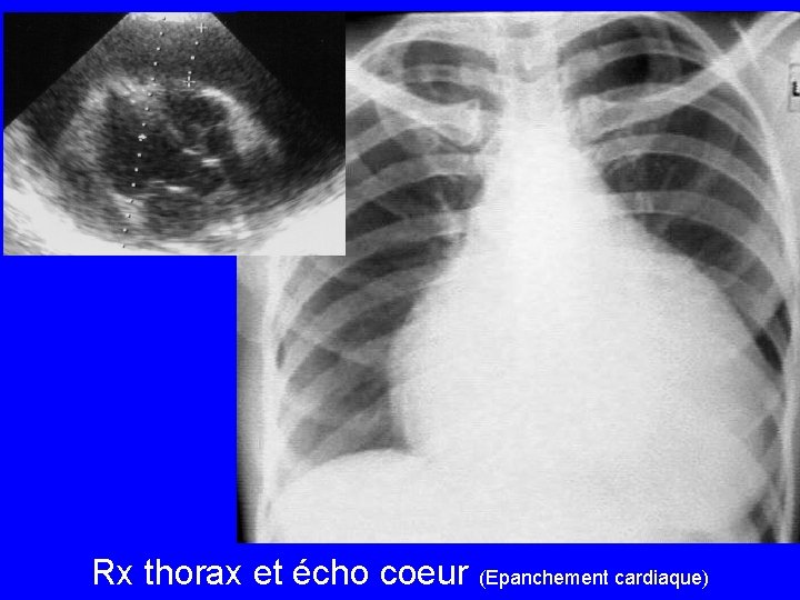 Rx thorax et écho coeur (Epanchement cardiaque) 