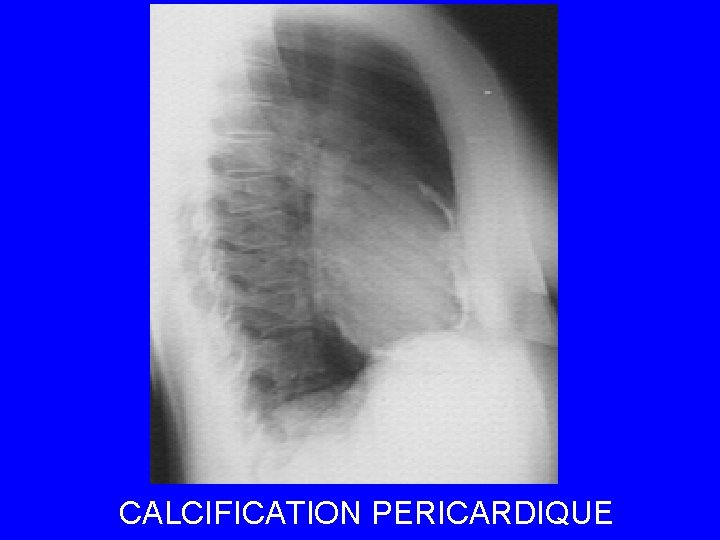 CALCIFICATION PERICARDIQUE 