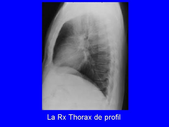 La Rx Thorax de profil 