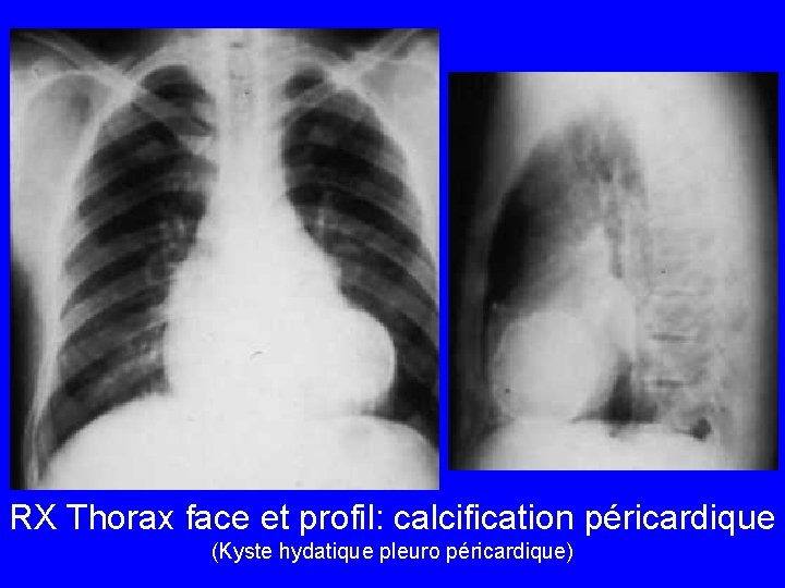 RX Thorax face et profil: calcification péricardique (Kyste hydatique pleuro péricardique) 