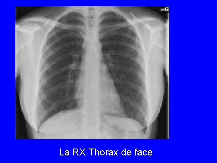 La RX Thorax de face 