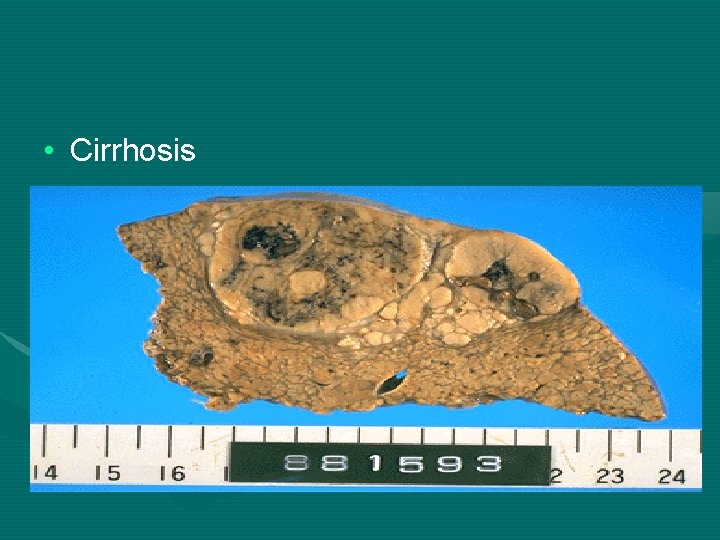  • Cirrhosis 