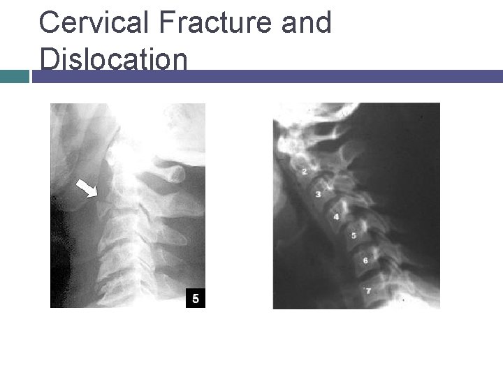 Cervical Fracture and Dislocation © 2007 Mc. Graw-Hill Higher Education. All rights reserved. 