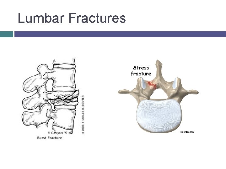 Lumbar Fractures © 2007 Mc. Graw-Hill Higher Education. All rights reserved. 