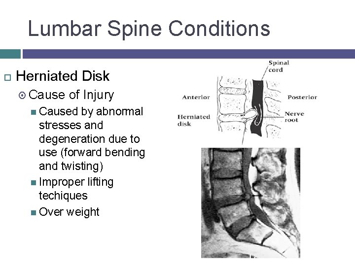 Lumbar Spine Conditions Herniated Disk Cause of Injury Caused by abnormal stresses and degeneration