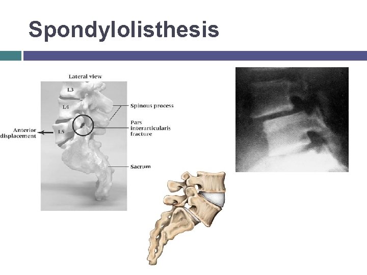 Spondylolisthesis © 2007 Mc. Graw-Hill Higher Education. All rights reserved. 