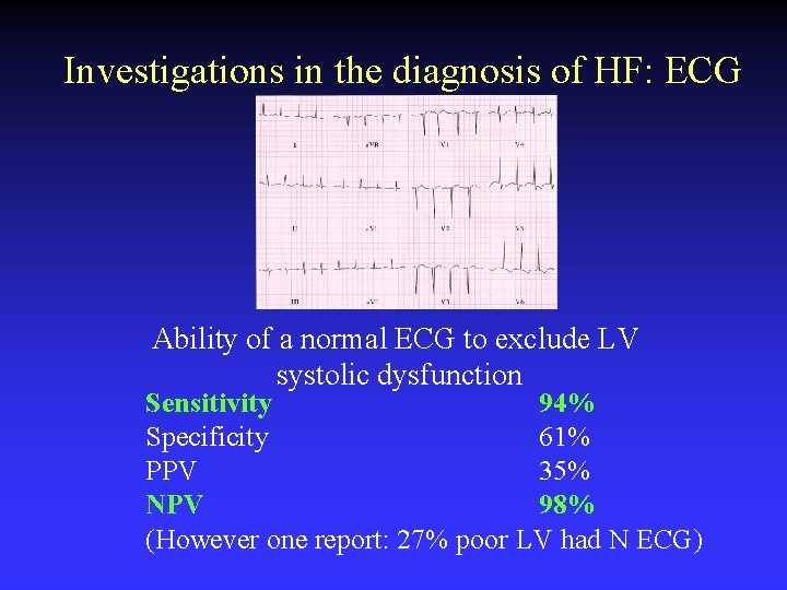 Investigations in the diagnosis of HF: ECG Ability of a normal ECG to exclude