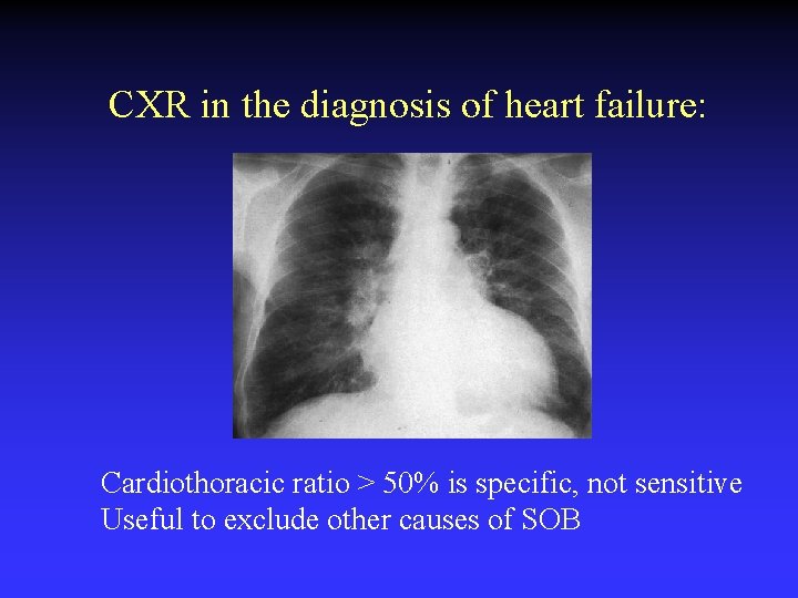 CXR in the diagnosis of heart failure: Cardiothoracic ratio > 50% is specific, not