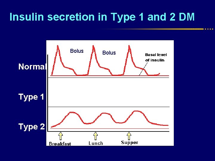 Insulin secretion in Type 1 and 2 DM Prandial Bolus Normal Type 1 Type