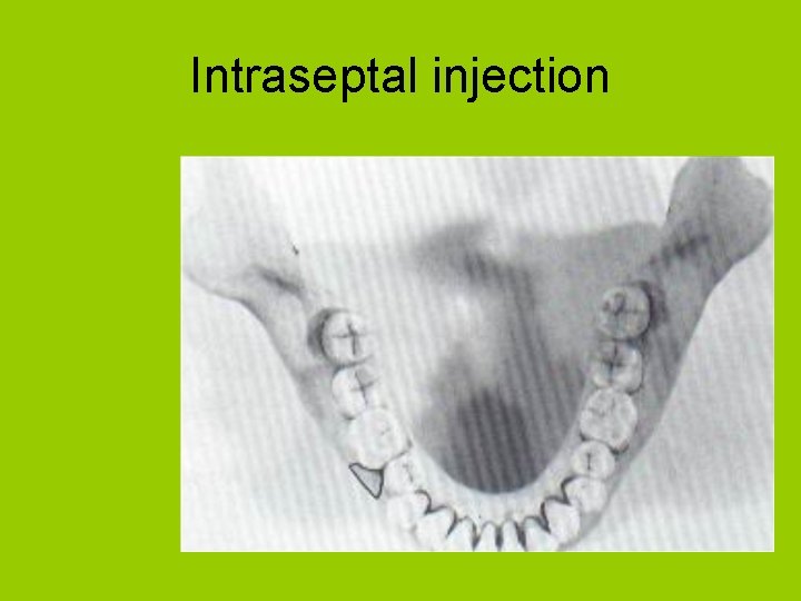 Intraseptal injection 