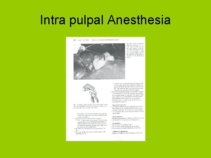 Intra pulpal Anesthesia 