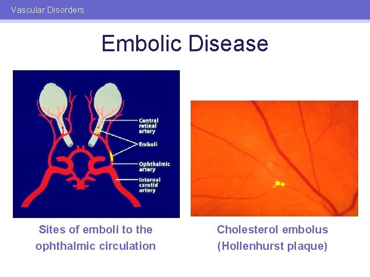 Vascular Disorders Embolic Disease Sites of emboli to the ophthalmic circulation Cholesterol embolus (Hollenhurst