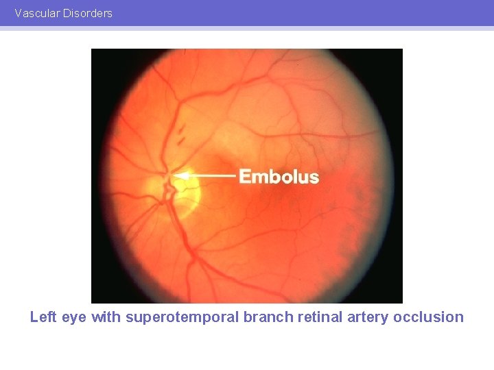 Vascular Disorders Left eye with superotemporal branch retinal artery occlusion 
