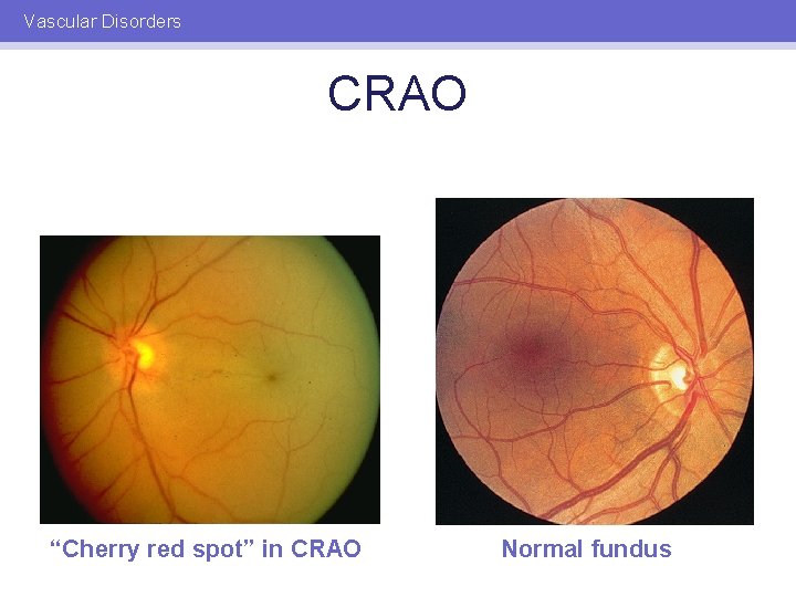 Vascular Disorders CRAO “Cherry red spot” in CRAO Normal fundus 