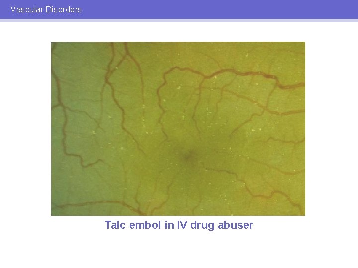 Vascular Disorders Talc embol in IV drug abuser 