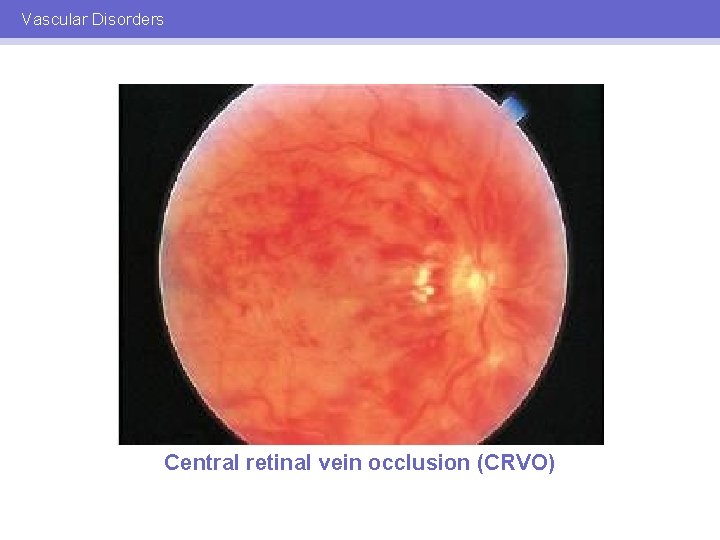 Vascular Disorders Central retinal vein occlusion (CRVO) 