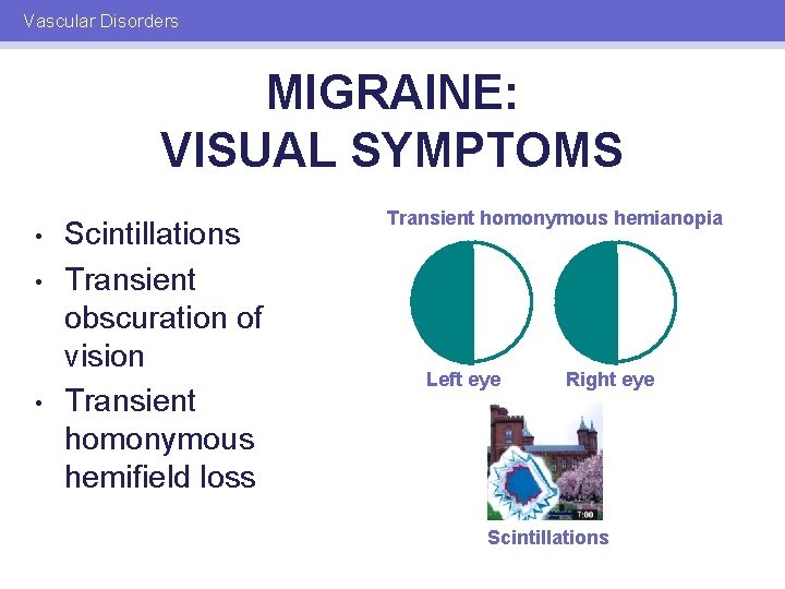 Vascular Disorders MIGRAINE: VISUAL SYMPTOMS • • • Scintillations Transient obscuration of vision Transient