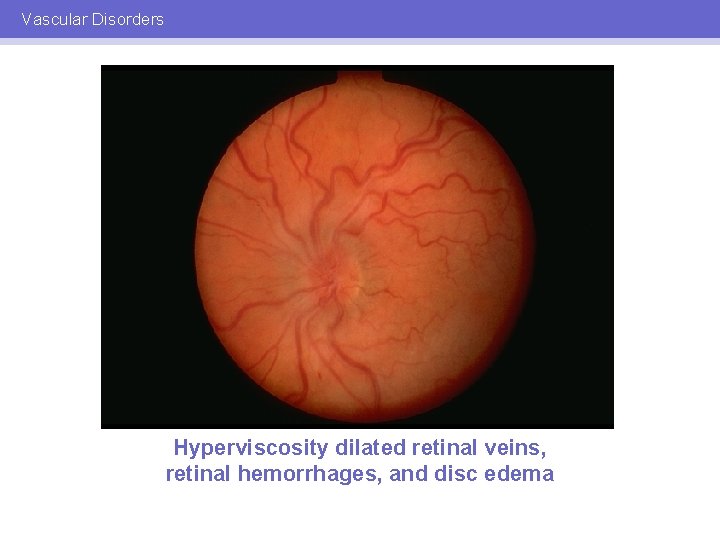 Vascular Disorders Hyperviscosity dilated retinal veins, retinal hemorrhages, and disc edema 