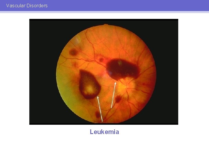 Vascular Disorders Leukemia 