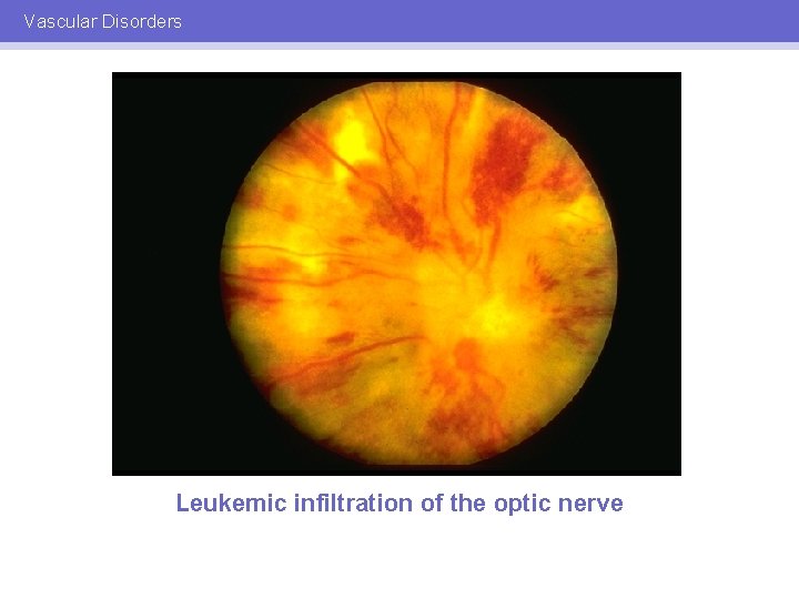Vascular Disorders Leukemic infiltration of the optic nerve 
