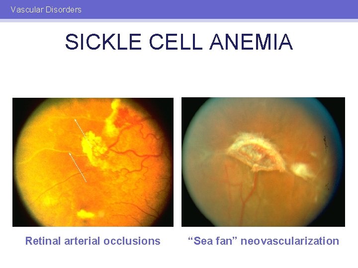 Vascular Disorders SICKLE CELL ANEMIA Retinal arterial occlusions “Sea fan” neovascularization 