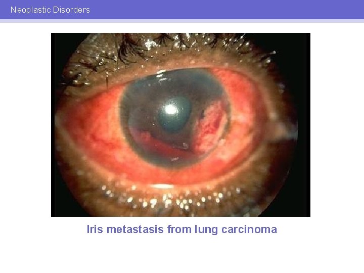 Neoplastic Disorders Iris metastasis from lung carcinoma 