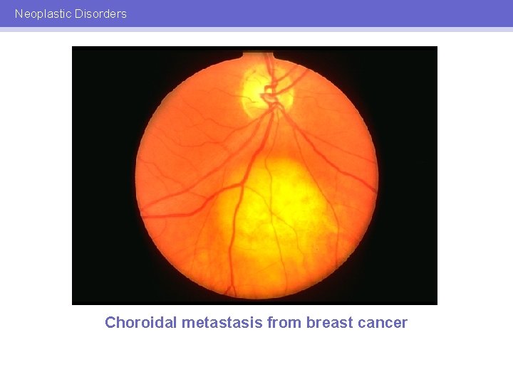 Neoplastic Disorders Choroidal metastasis from breast cancer 