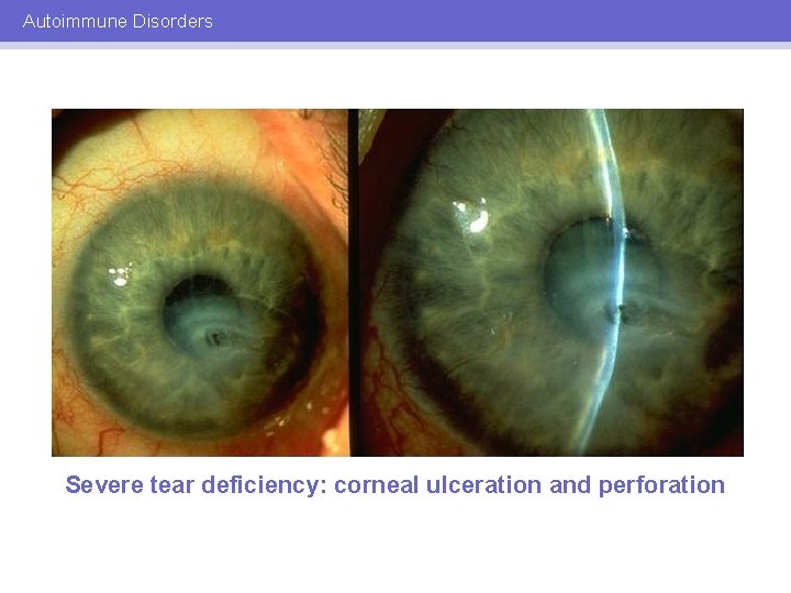 Autoimmune Disorders Severe tear deficiency: corneal ulceration and perforation 