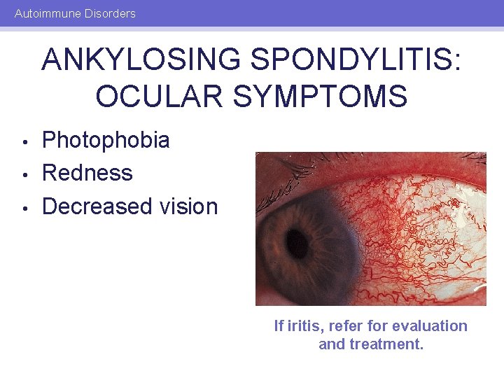 Autoimmune Disorders ANKYLOSING SPONDYLITIS: OCULAR SYMPTOMS • • • Photophobia Redness Decreased vision If