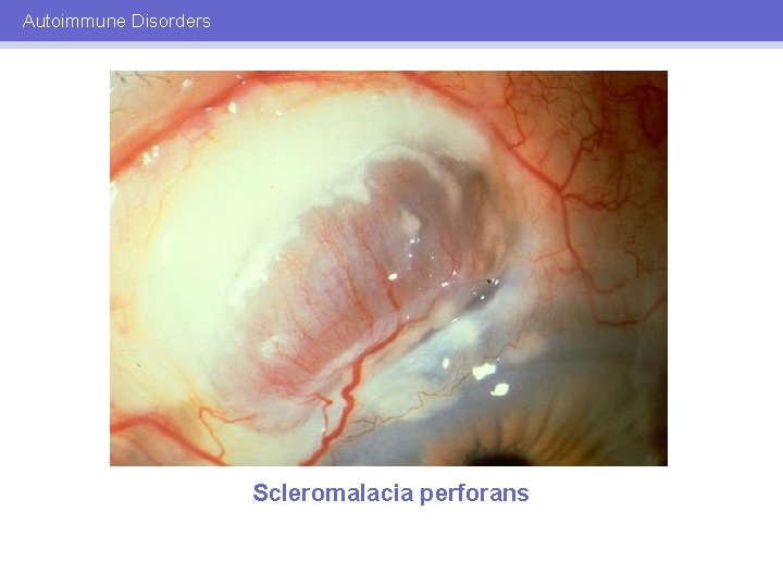 Autoimmune Disorders Scleromalacia perforans 