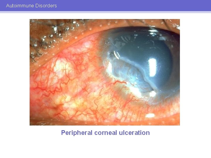 Autoimmune Disorders Peripheral corneal ulceration 