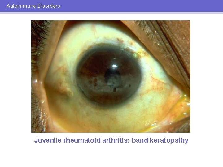 Autoimmune Disorders Juvenile rheumatoid arthritis: band keratopathy 