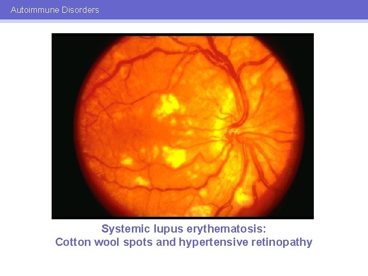 Autoimmune Disorders Systemic lupus erythematosis: Cotton wool spots and hypertensive retinopathy 