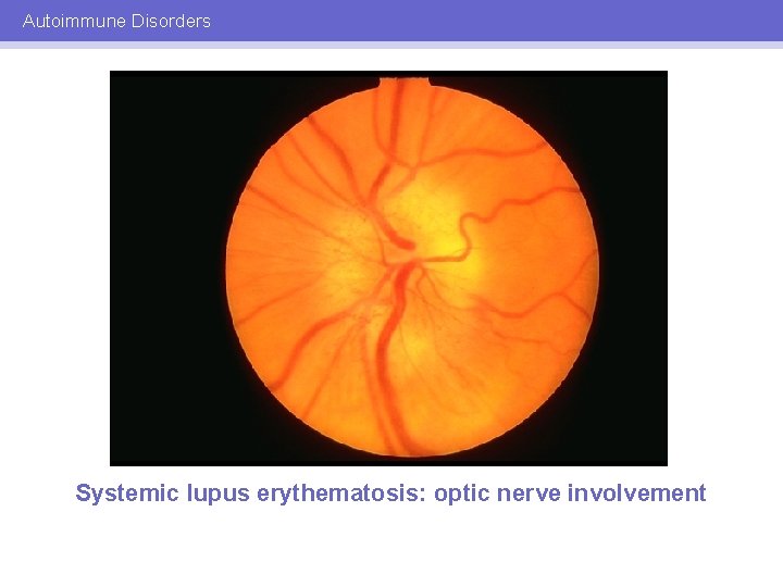 Autoimmune Disorders Systemic lupus erythematosis: optic nerve involvement 