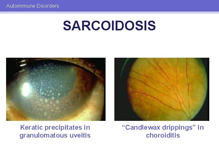 Autoimmune Disorders SARCOIDOSIS Keratic precipitates in granulomatous uveitis “Candlewax drippings” in choroiditis 
