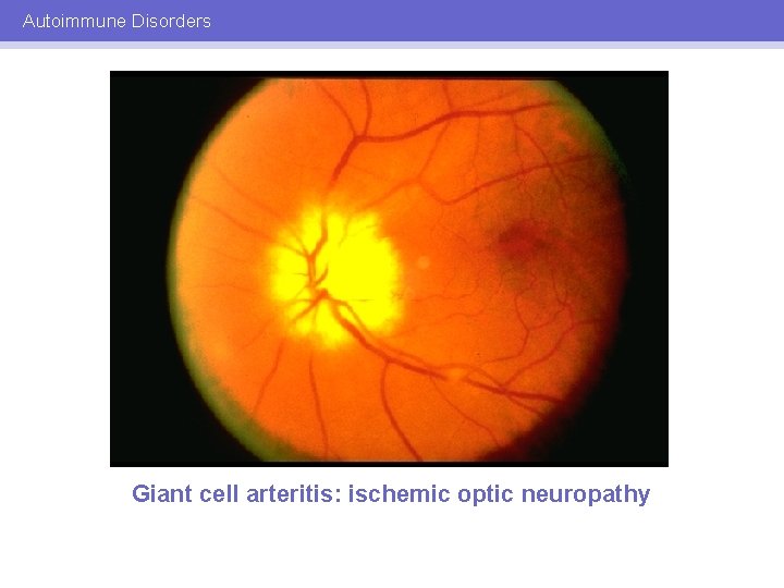 Autoimmune Disorders Giant cell arteritis: ischemic optic neuropathy 