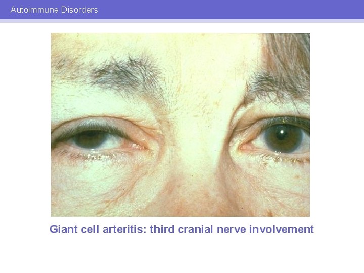 Autoimmune Disorders Giant cell arteritis: third cranial nerve involvement 