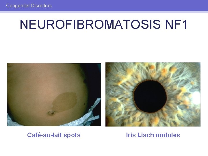 Congenital Disorders NEUROFIBROMATOSIS NF 1 Café-au-lait spots Iris Lisch nodules 