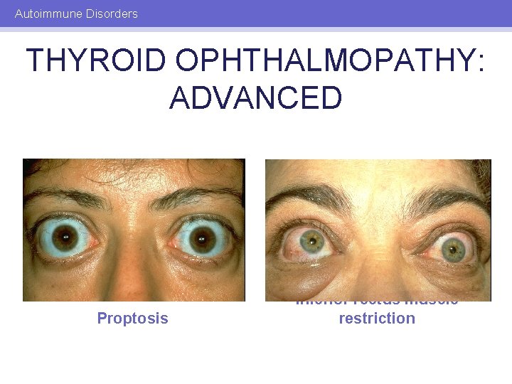 Autoimmune Disorders THYROID OPHTHALMOPATHY: ADVANCED Proptosis Inferior rectus muscle restriction 