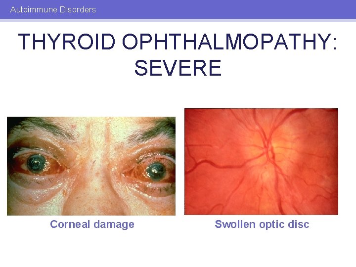 Autoimmune Disorders THYROID OPHTHALMOPATHY: SEVERE Corneal damage Swollen optic disc 