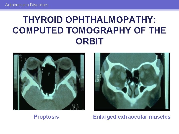Autoimmune Disorders THYROID OPHTHALMOPATHY: COMPUTED TOMOGRAPHY OF THE ORBIT Proptosis Enlarged extraocular muscles 