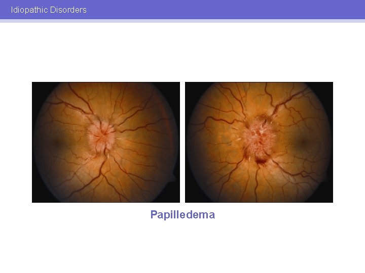 Idiopathic Disorders Papilledema 