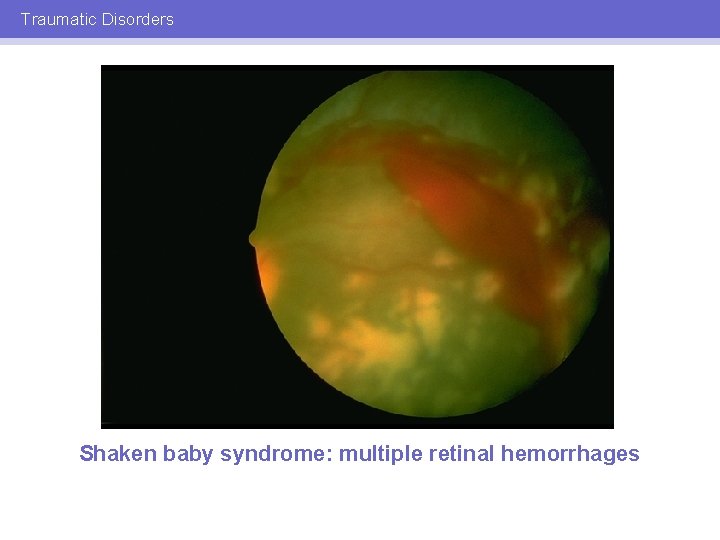 Traumatic Disorders Shaken baby syndrome: multiple retinal hemorrhages 