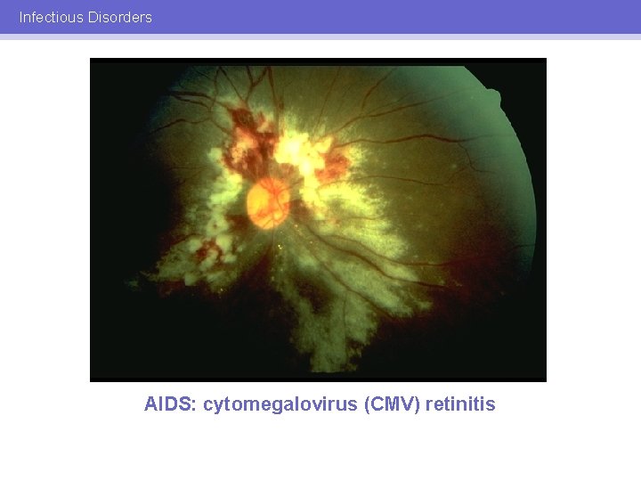 Infectious Disorders AIDS: cytomegalovirus (CMV) retinitis 