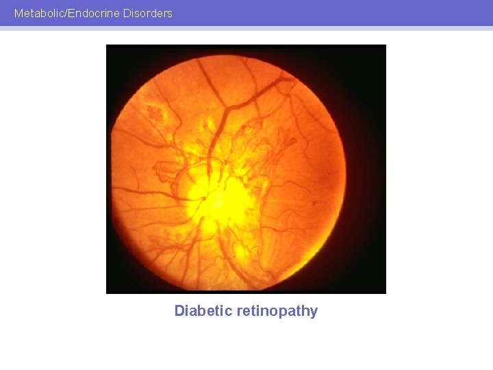 Metabolic/Endocrine Disorders Diabetic retinopathy 