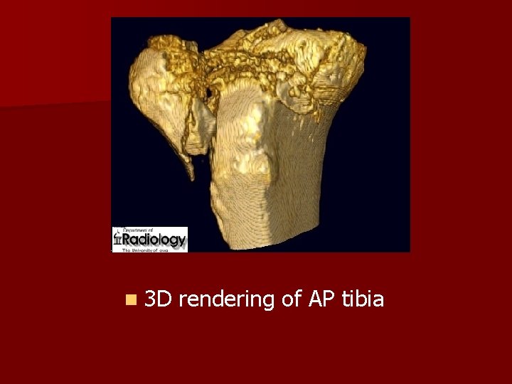 n 3 D rendering of AP tibia 