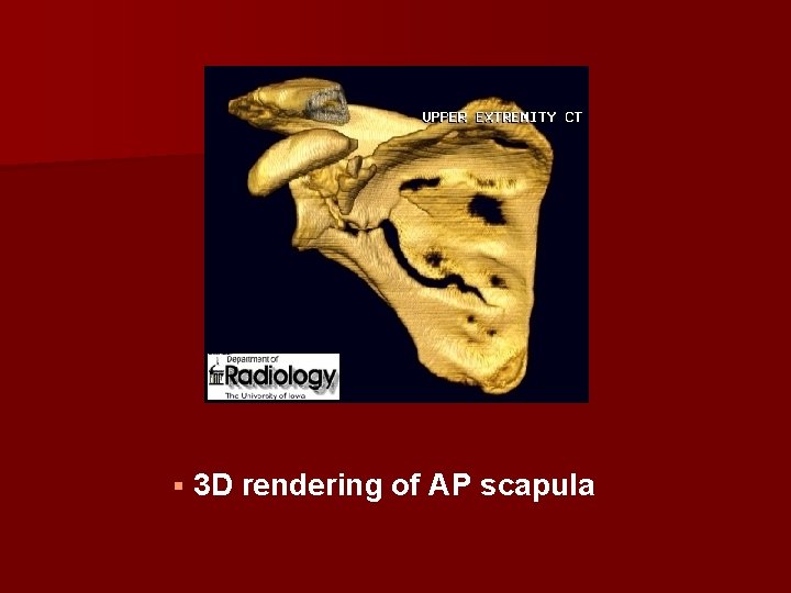 § 3 D rendering of AP scapula 