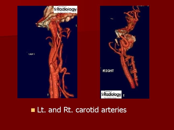 n Lt. and Rt. carotid arteries 