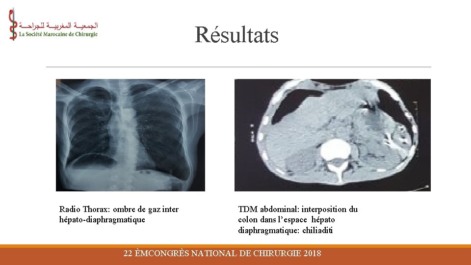 Résultats Radio Thorax: ombre de gaz inter hépato-diaphragmatique TDM abdominal: interposition du colon dans